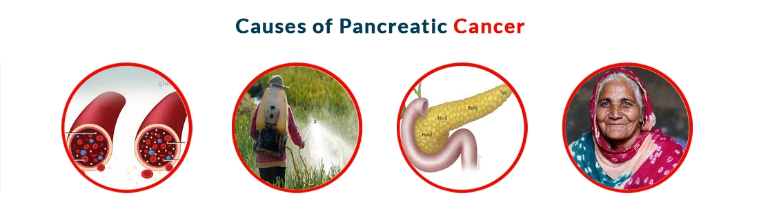Causes of Pancreatic Cancer